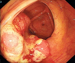 大腸內壁的腫瘤