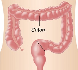 Colon Colon